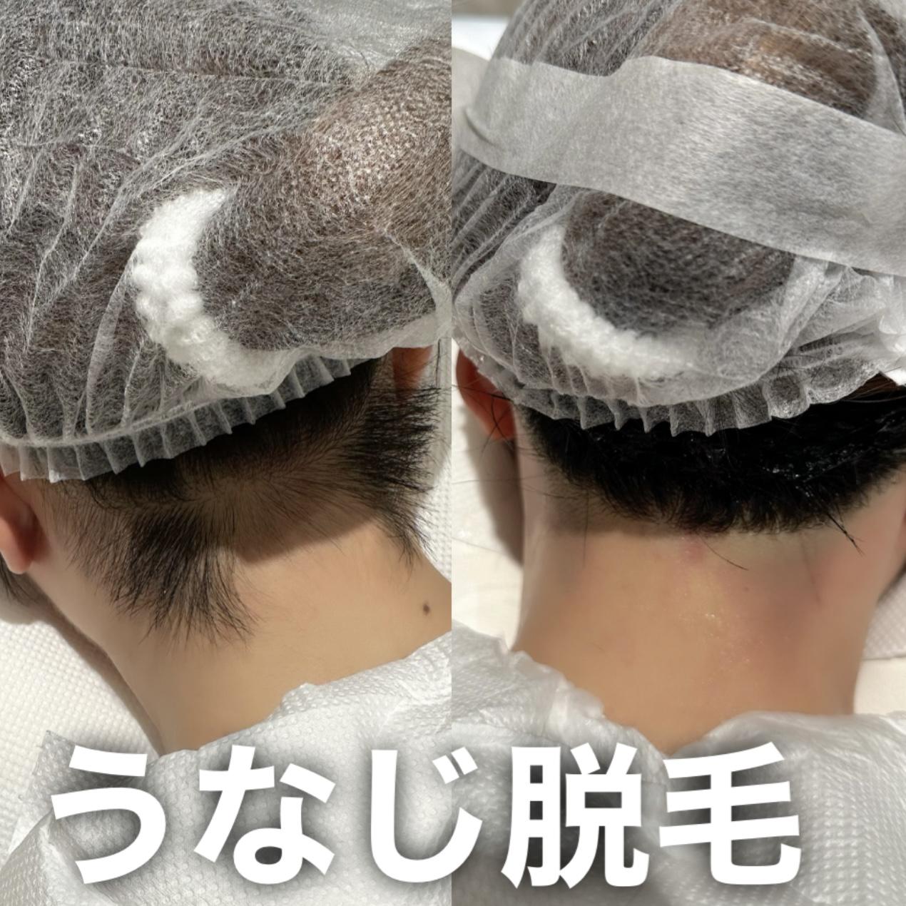 うなじ脱毛をレポート！