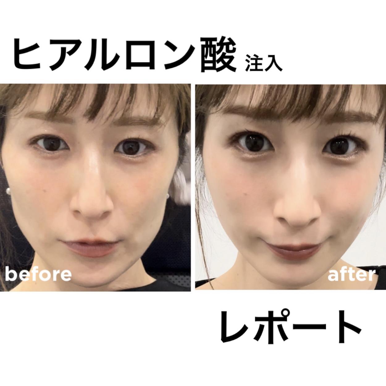 "ヒアルロン酸"注入レポート！