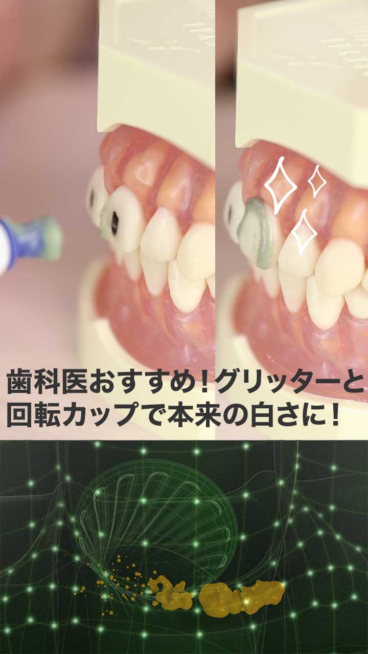 歯を本来の白さに！歯科医おすすめグリッター＆回転カップの電動トゥースクリーナー
