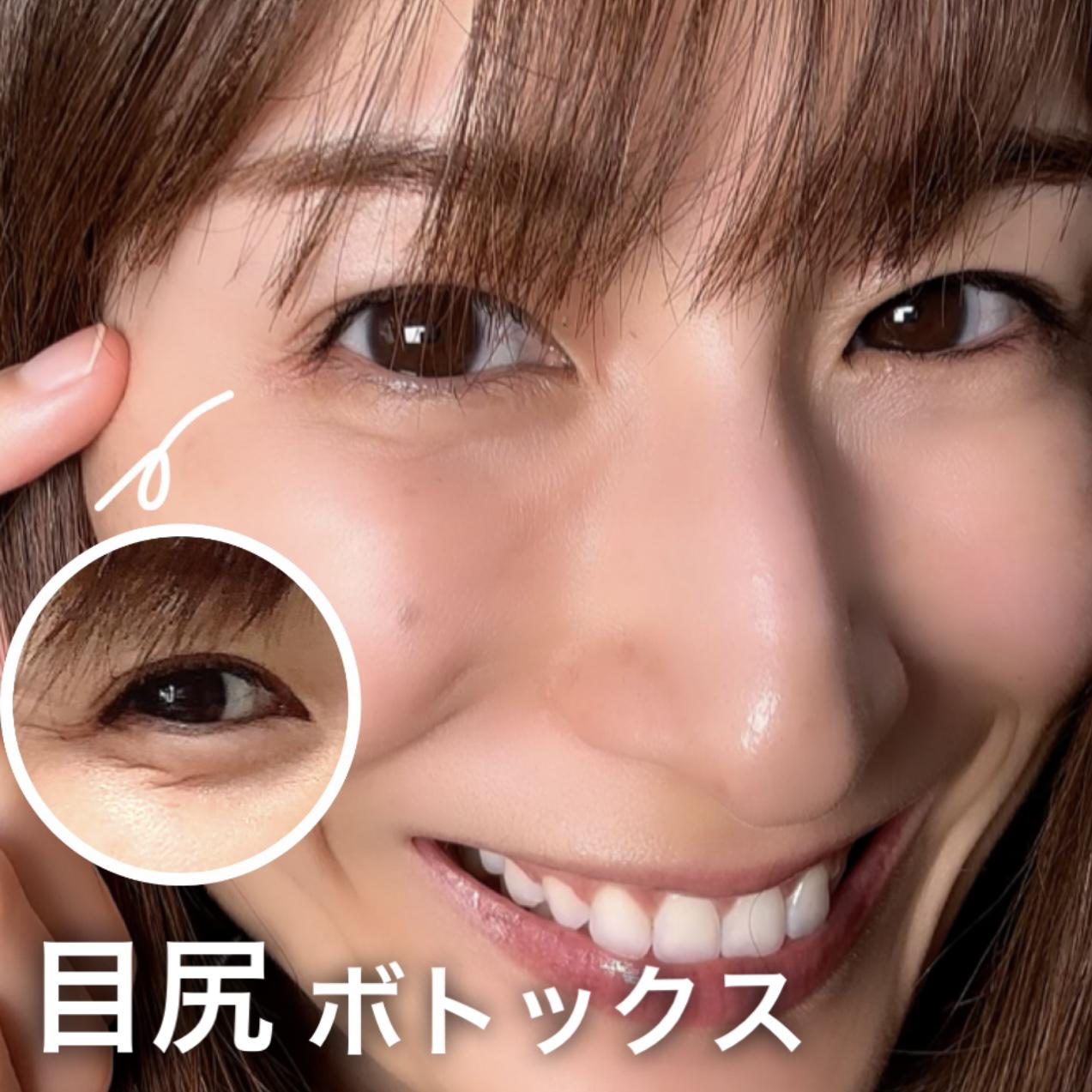 "目尻"ボトックスレポート！