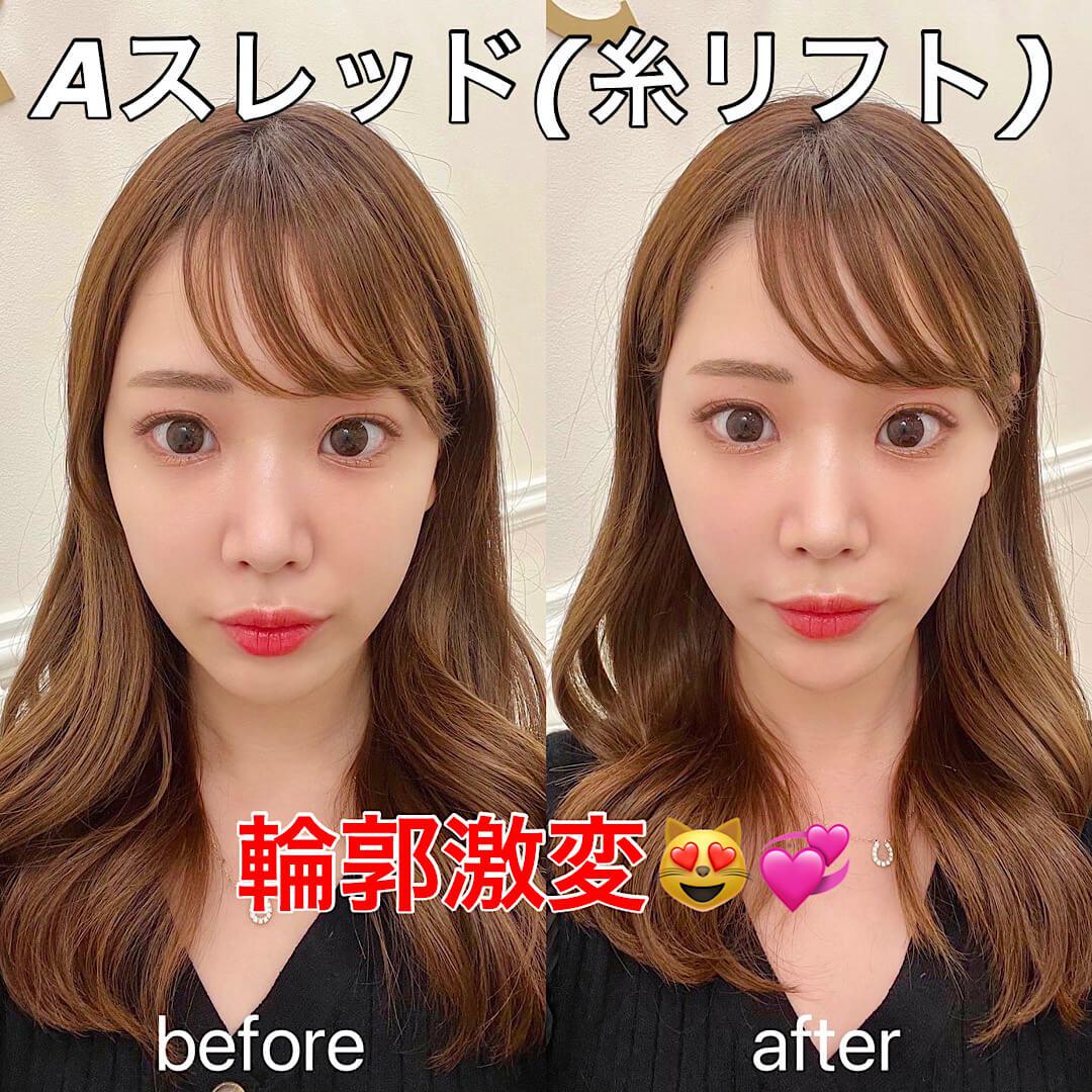 話題のAスレッド(糸リフト)やってきました♡